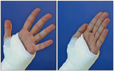 Øvelser for hånd i gips
