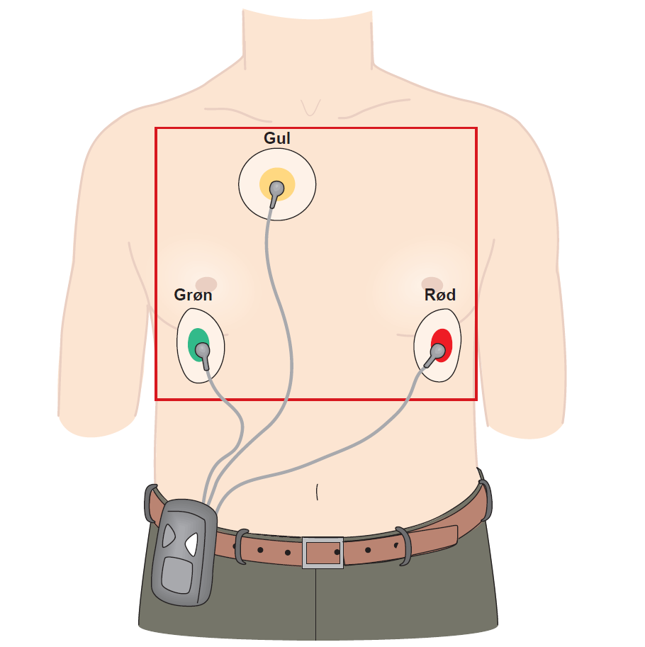 Optager med tre elektroder med farverne grøn, gul og rød, som er sat på brystkassen.