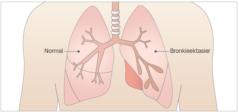 Illustration af en normal lunge og en lunge med bronkietasier. 