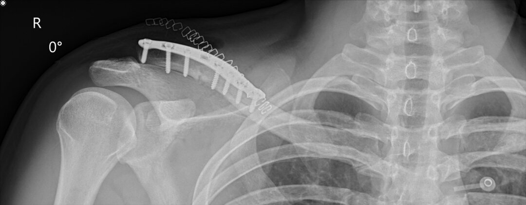 Et røntgenbillede af et brud på kravebenet med skinne.