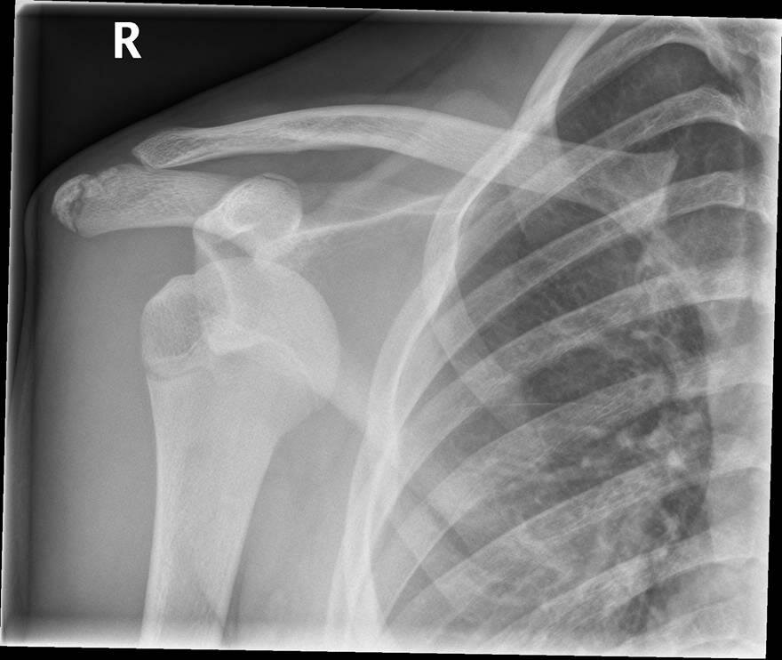Et røntgenbillede af en skulder, der er gået af led. 
