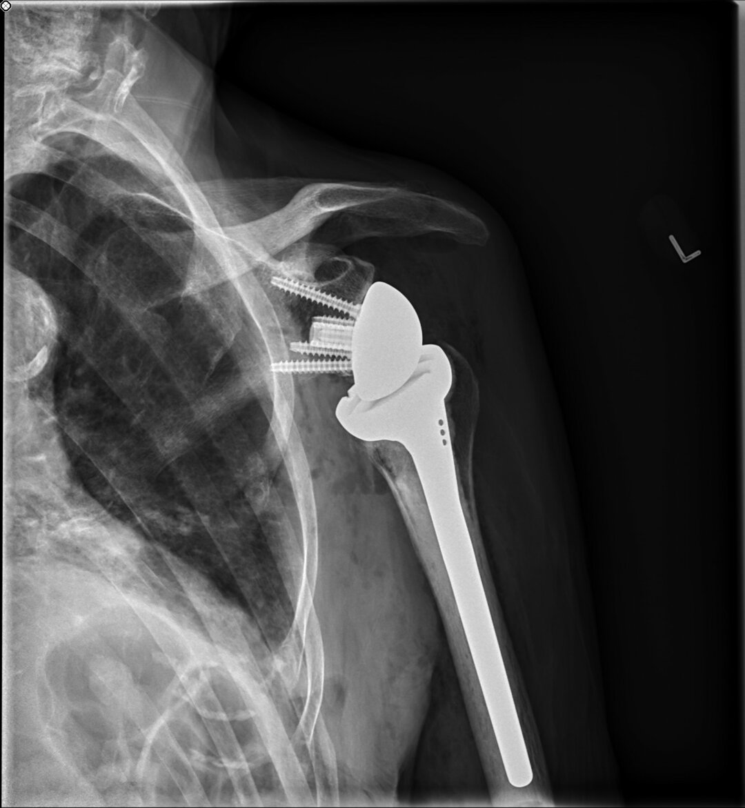 Et røntgenbillede af høre skulder med "omvendt protese". 