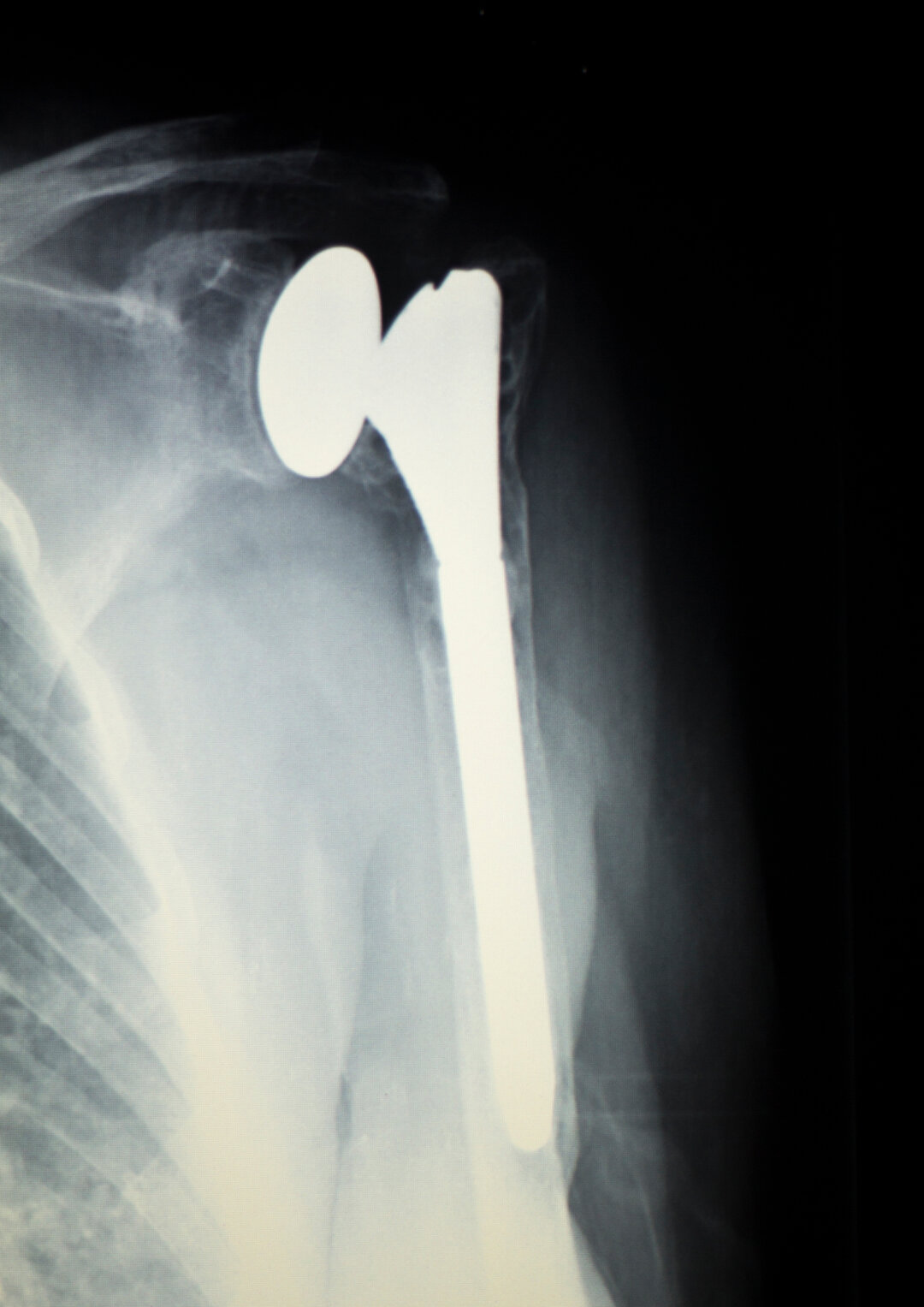 Et røntgenbillede af venstre skulder med "halv protese". 