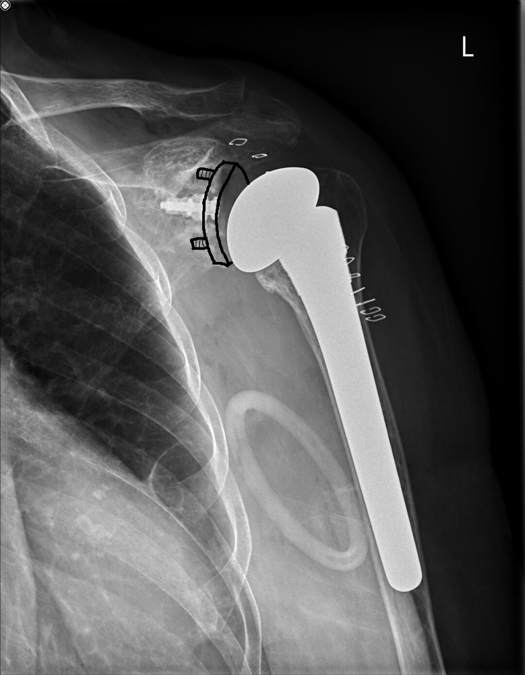 Et røntgenbillede af højre skulder med "anatomisk protese".