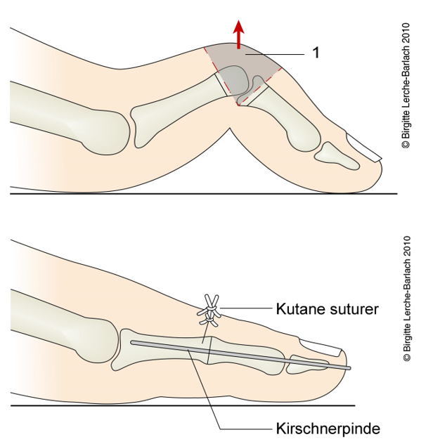 En illustration af en hammertå før og efter operation. 