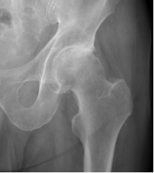 Et røntgenbillede af en hofte med slidgigt. 