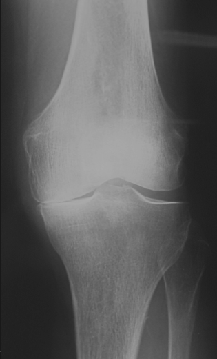 Et røntgenbillede af et knæ med halvsidig gigt uden protese.