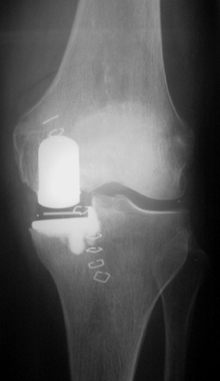 Et røntgenbillede af et knæ med halvsidig slidgigt med protese.