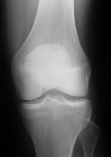 Et røntgenbillede af et normalt knæ.