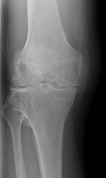 Et billede af et knæ med artrose uden protese. 