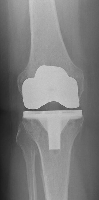 Et billede af et knæ med artrose med protese