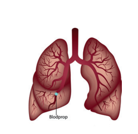 En illustration af lungerne, hvor det er markeret med en cirkel, hvor blodproppen sidder. 