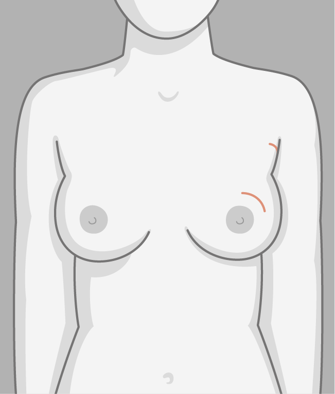 En illustration af den brystbevarende operation.