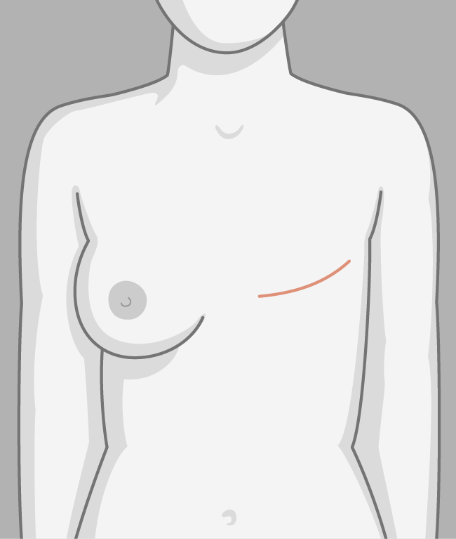En illustration af, at brystet er fjernet ifm. operation. 