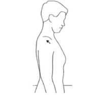 Tegning af patient fra siden, med en pil på skulderen