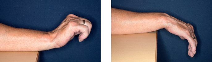 Venstre billede viser, håndleddet bøjet bagover med bøjede fingre. Højre billede viser, håndleddet bøjet nedad i afslappet tilstand.