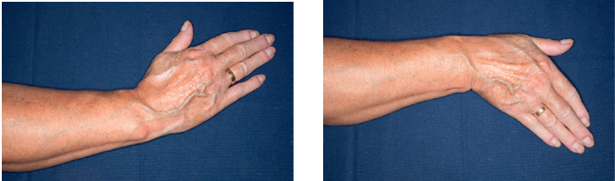Venstre billede viser, håndleddet bøjet mod tommelfingeren. Venstre billede viser, håndleddet bøjet mod lillefingeren.