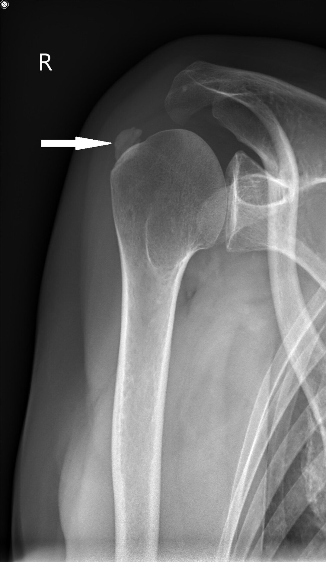 Røntgenbillede af højre skulder
