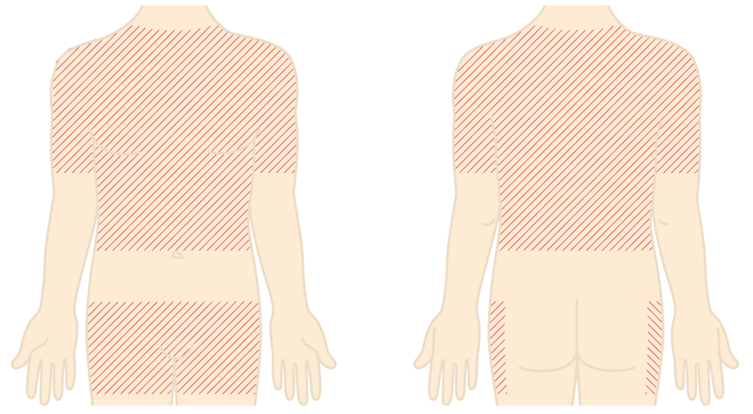 Illustration af området, der skal fjernes hår fra