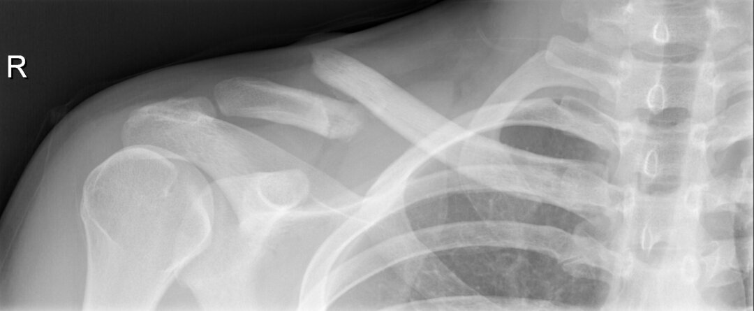 Et røntgenbillede af et brud på kravebenet.