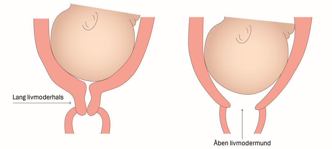 Illustration af en lang livmoderhals og en åben livmodermund
