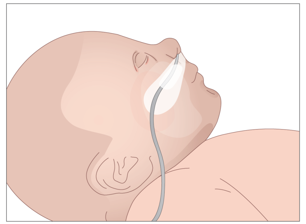Illustration af baby med sonde.