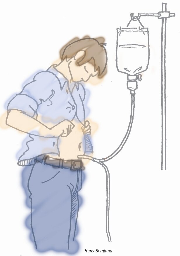 På tegningen vises en patient, i oprejst position, som har fået anlagt et krøllekateter.