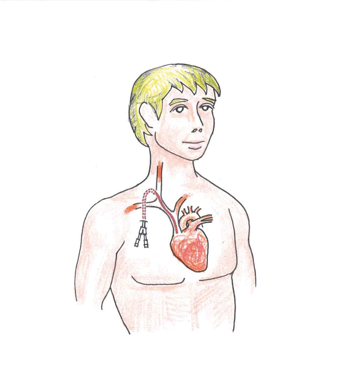En tegning af en mand, der har fået permanent dialysekateter.