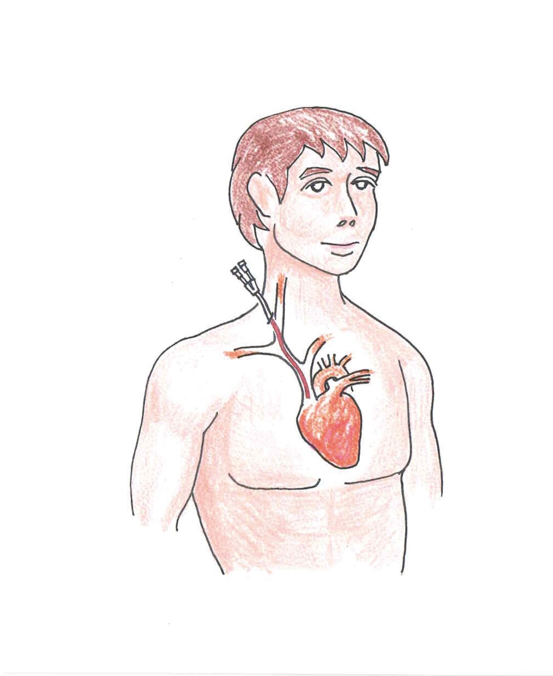 En tegning af en patient med midlertidigt dialysekateter.