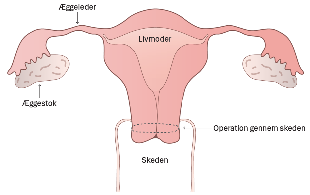 Illustration af livmoderen.