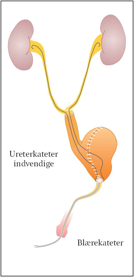 En illustration af en urinblæren.