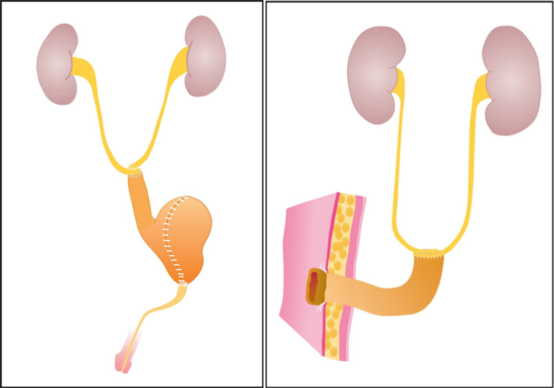 En illustration af en tarmblære og en urinblære.
