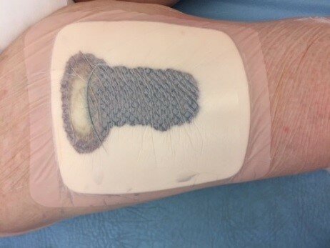 Et billede af donorstedet på låret.