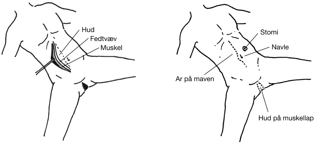 Illustrationerne viser, at muskellappen er syet ind i defekten.