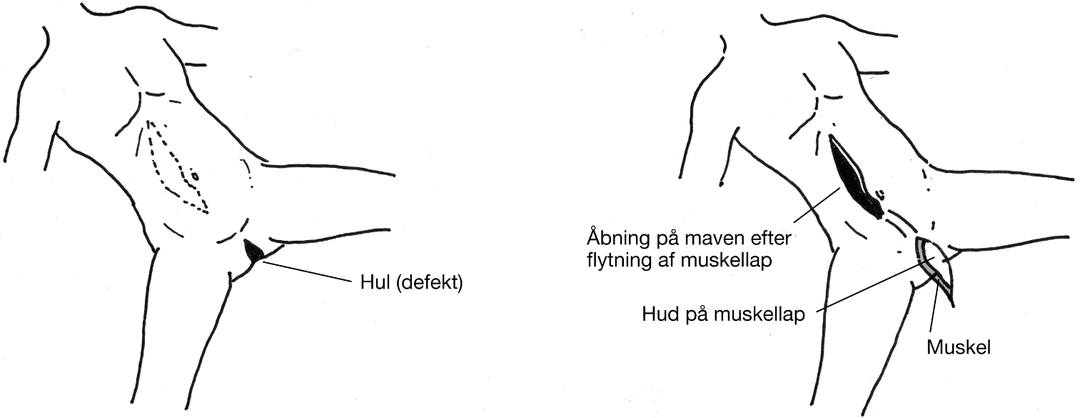 Illustrationerne viser, at muskellappen er drejet på plads i hullet (defekten).