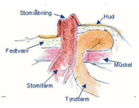 Illustration af stomiåbning, hud, fedtvæv, stomitarm, tyndtarm og muskel.