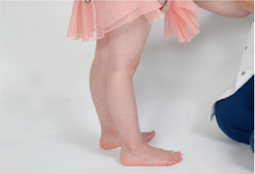 Et billede af et barn, der har overstrakte knæ.