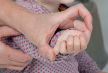 Et billede af et barn, der har overstrakte fingerled. 