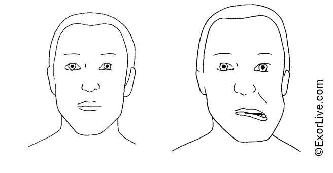 Illustration af sideforskydning af kæben. 