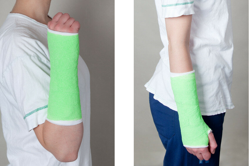 Armen i gips