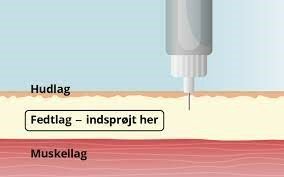 Illustrationen viser, hvor man skal lave indsprøjtningen. Den skal laves i fedtlaget, som er mellem hudlag og muskellag. 