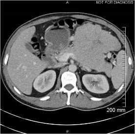 CT-skanning af maven (abdomen), et enkelt snitbillede