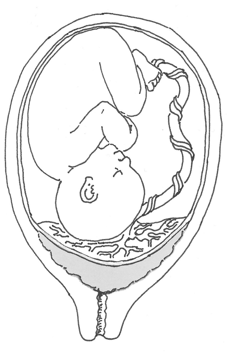 Foranliggende moderkage (Placenta prævia)