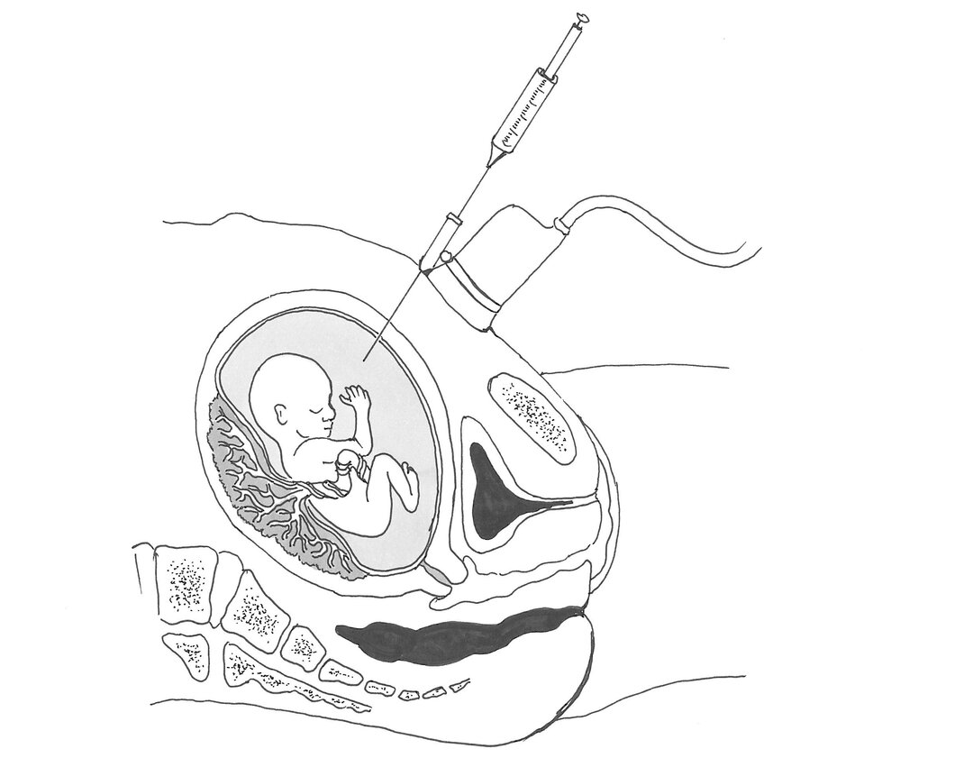 Ved en fostervandsprøve stikkes en tynd nål gennem maveskindet og suger en lille mængde fostervand ud. Illustration af Randi Iversen