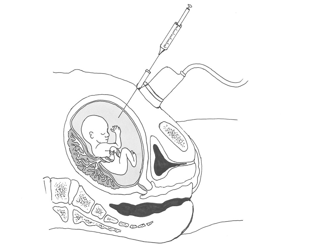The picture shows how a thin needle is inserted through the abdominal wall to extract a small sample of amniotic fluid.