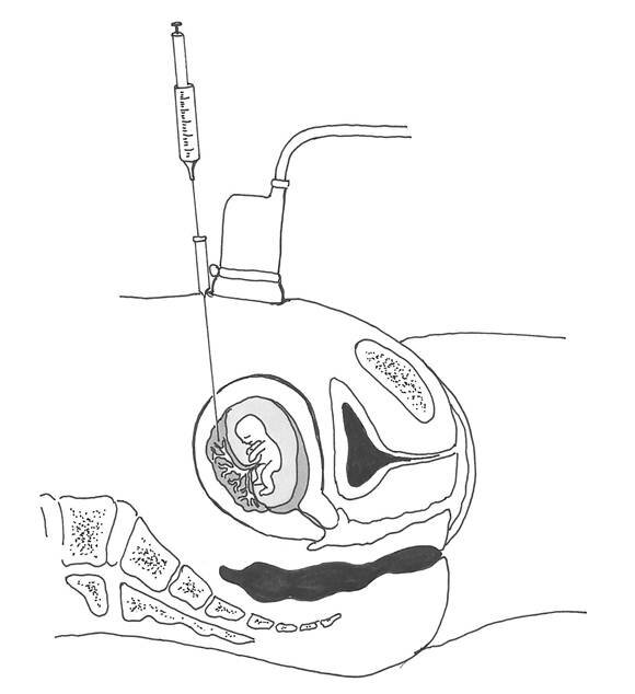 The picture shows how a small needle is inserted through the stomach to extract a small sample of the placenta.