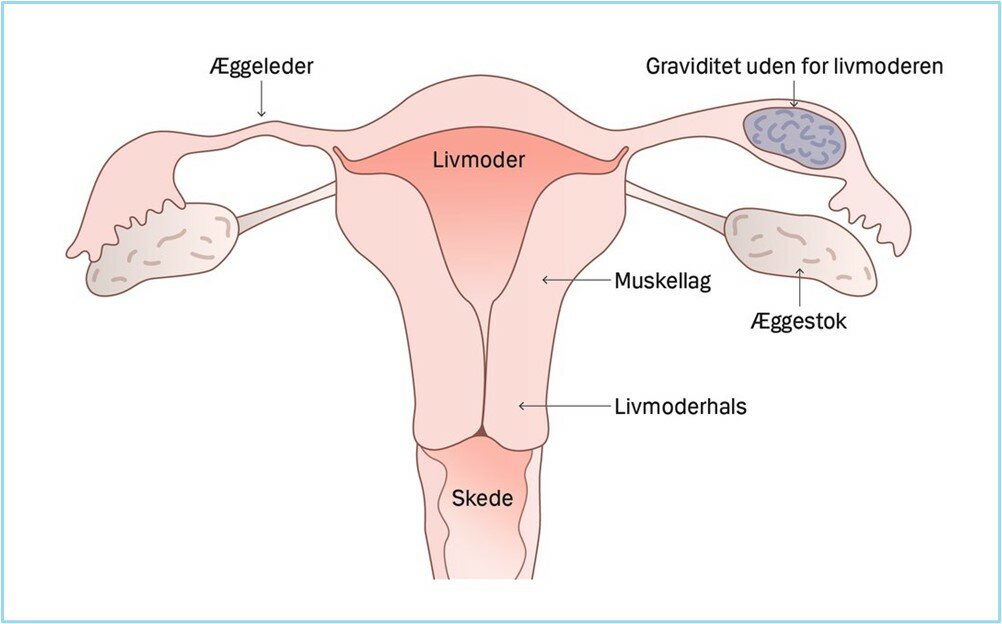Graviditet uden for livmoderen