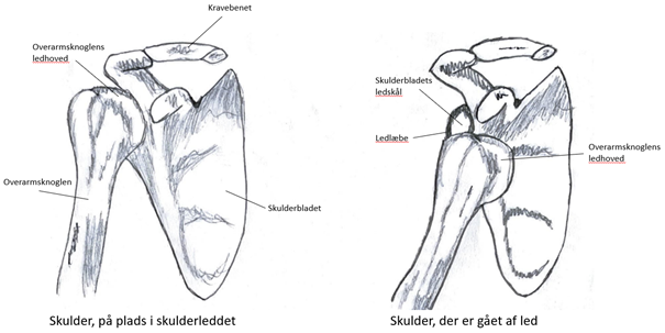 Illustration af skulder i led og skulder ude af led