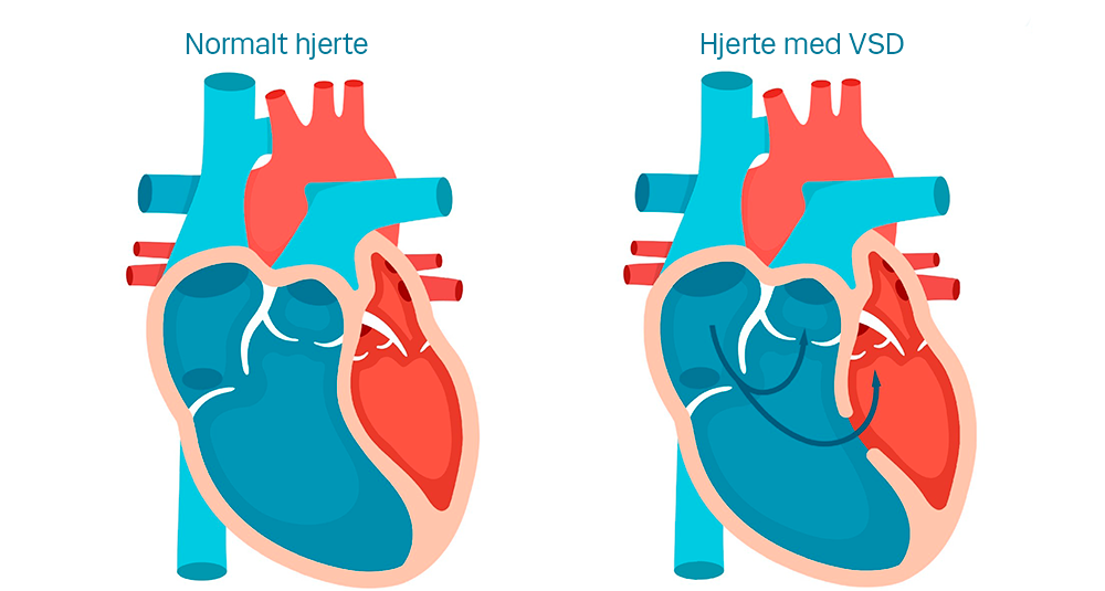 Illustration af normalt hjerte og hjerte med vsd