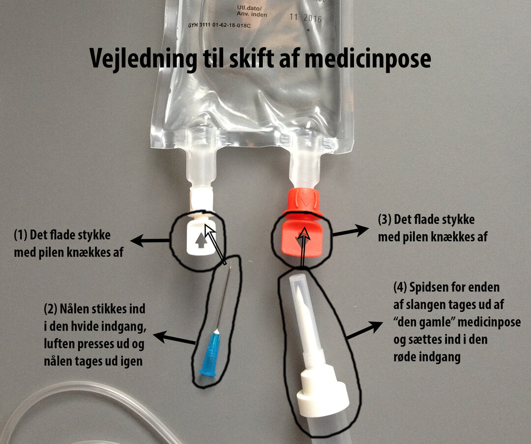 Billedet viser en vejledning for skift af medicinpose: 1. Det flade stykke (hvid) med pilen knækkes af. 2. Nålen stikkes ind i den hvide indgang, luften presses ud og nålen tages ud igen. 3. Det flade stykke (rød) med pilen knækkes af. 4. Spidsen for enden af slangen tages ud af "den gamle" medicinpose og sættes ind i den røde indgang.